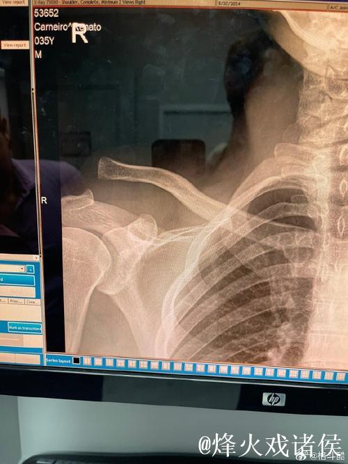 马纳里诺无情出击，瓦林卡满场飞奔疲于应对，四蛋无辜受虐